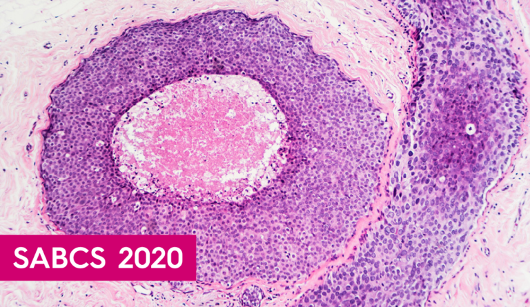 DCIS tumor cells