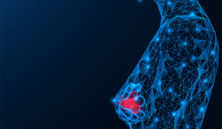 an illustration of an outline of a woman in blue with pink indicating presence of breast cancer in her breast