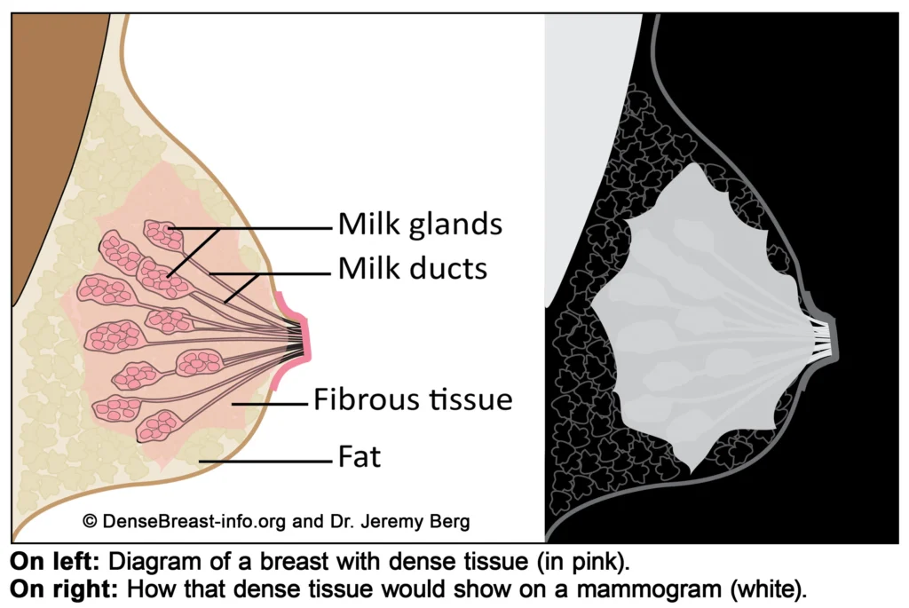 Diagram of a genetic female's breast tissue showing milk glands, milk ducts, fibrous tissue, and fat. A black and white image to the right shows how dense breast tissue would appear on a mammogram